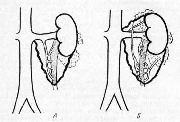 Варианты артериального кровоснабжения мочеточника трансплантата и форма его «брыжейки» (Б. П. Комиссаров, 1969)