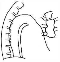 Отчетливая видимость грудной аорты при атеросклерозе (первое косое положение).