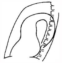 Развернутая аорта при атеросклерозе (второе косое положение). 