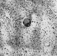 Бруцеллезная гранулома, состоящая из эпителиоидных клеток. В центре - гигантская клетка.