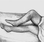 Двусторонний гонит с контрактурой правого коленного сустава при бруцеллезе.