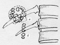 Схема рентгеновского снимка камней желчного протока (а) и общего желчного протока (б).