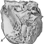 Хроническая аневризма (А) левого желудочка сердца на почве рубцового замещения ткани миокарда после инфаркта.