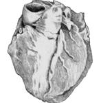 Атеросклероз венечной артерии сердца.