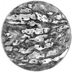 Ксантомные клетки в атеросклеротической бляшке 