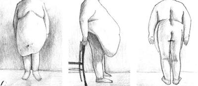 Больной ожирением (тяжелая форма), 47 лет, рост 175 см, вес 206,0 кг.
