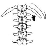 Схема рентгеновского снимка при лоханочном камне почки.