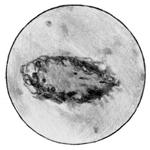 Сибиреязвенный менингоэнцефолит. Масса бацилл кольцом окружают сосуд.