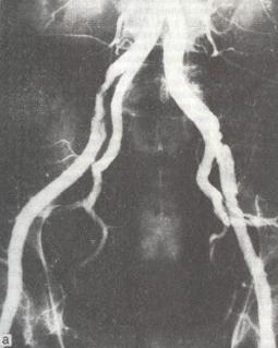 Атеросклеротическое поражение подвздошных артерий