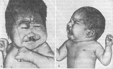 Новорожденные девочки с синдромом трисомии