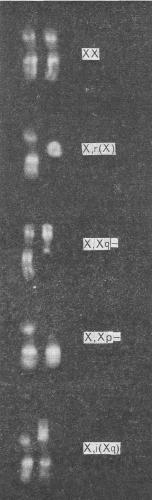 Структурные аберрации Х-хромосом