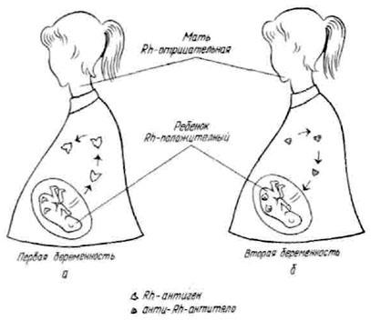 Гемолитическая болезнь новорожденных (ГБН) - врожденное заболевание