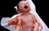 Герпетические инфекции у новорожденных