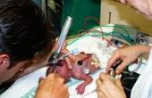 Пережитая при рождении клиническая смерть приводит к снижению коэффициента IQ