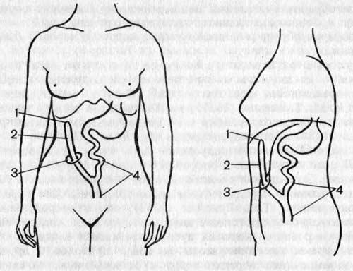 Соустье общего печеночного протока с желудочно-кишечным трактом