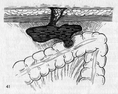 Несформированный кишечный свищ через полость