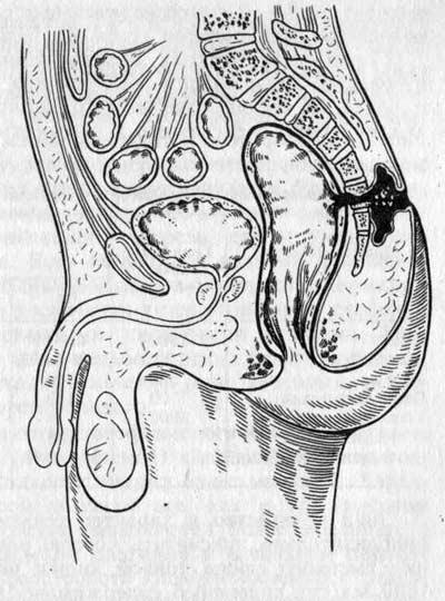 Строение осложненного свища прямой кишки
