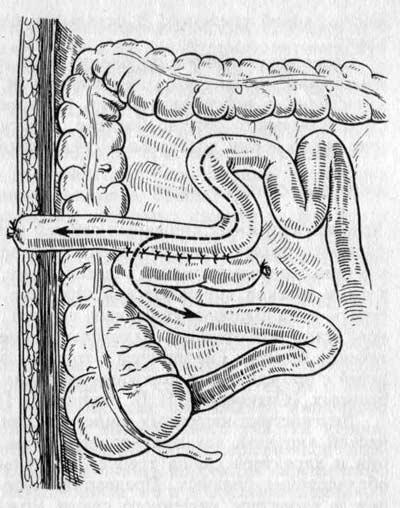 Формирование разгрузочной энтеростомы