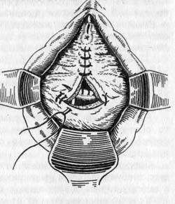 Операция по поводу пузырно-влагалищного свища