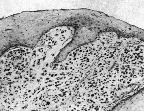 Клетки перстневидноклеточного рака