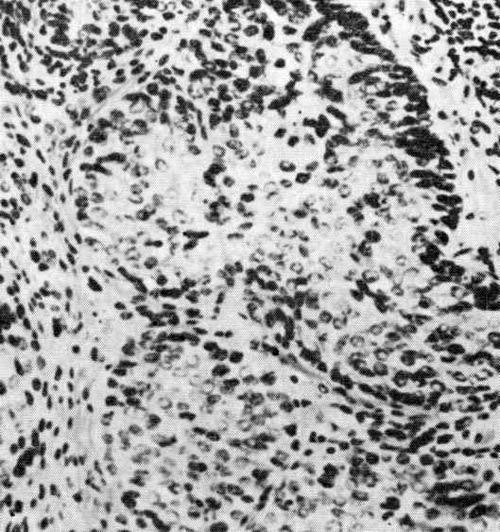 Плоскоклеточный и базальноклеточный рак кожи перианальной области и анального канала (анаплазия ядер)