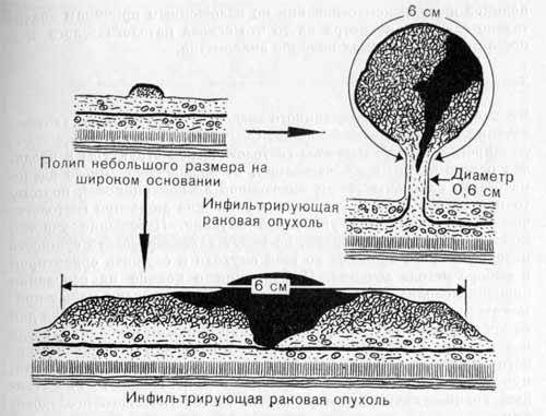 Опухолевая ткань в полипе на ножке