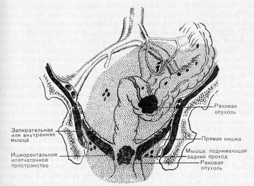 Хирургическое лечение рака прямой кишки