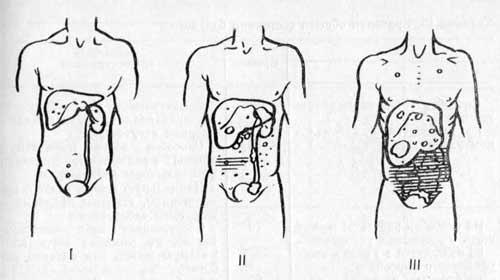 Распространение по брюшине