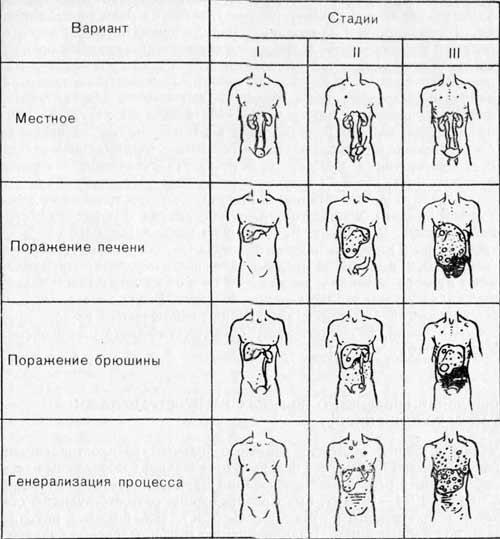 Распространенный рак толстой кишки