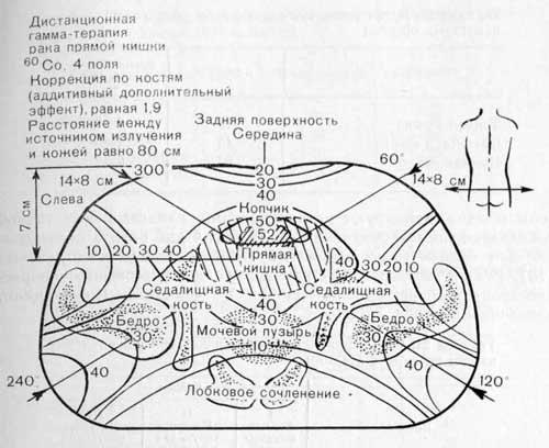 Дистанционная лучевая терапия рака прямой кишки