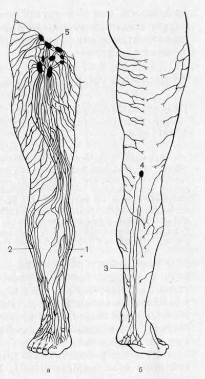 Поверхностные лимфатические сосуды нижней конечности