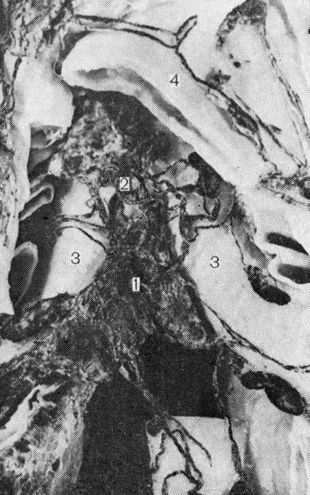 Нижние трахеобронхиальные лимфатические узлы (выносящие лимфатические сосуды)