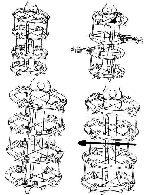 Схемы компоновки аппарата Илизарова