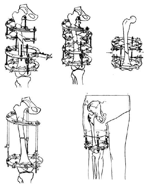 Схемы компоновки аппарата Илизарова при переломах бедра