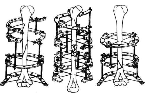 Схемы компоновки аппарата Илизарова при переломах плечевой кости