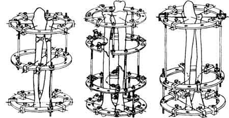Схемы компоновки аппарата Илизарова при переломах лучевой кости
