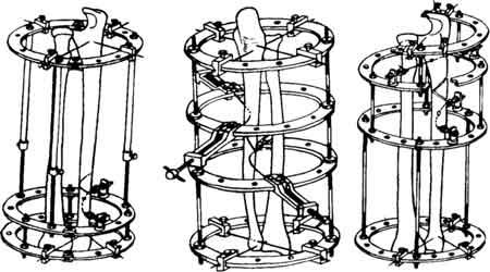 Схемы компоновки аппарата Илизарова при переломах локтевой кости