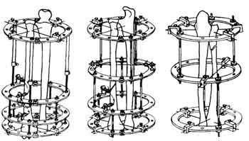Схемы компоновки аппарата Илизарова при переломах обеих костей предплечья