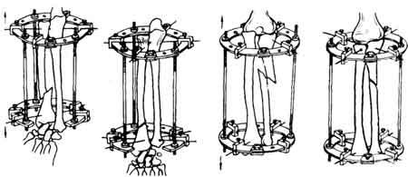 Схемы компоновки аппарата Илизарова при переломо-вывихах костей предплечья