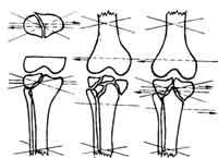 Схемы проведения спиц при переломах мыщелков большеберцовой кости