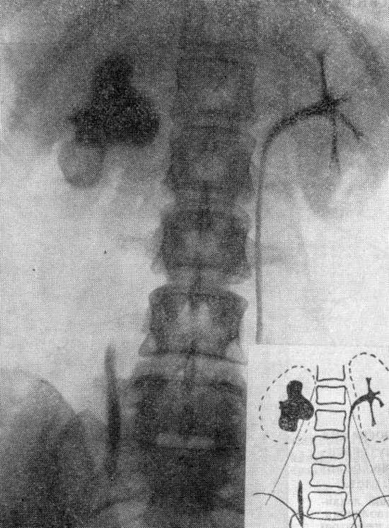 Рентгенологическая картина гидронефроза у больных с АГ