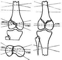 Схемы проведения спиц при переломах мыщелков бедренной кости