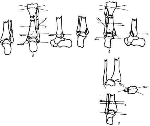 Сложные переломы костей голеностопного сустава (устранение смещений)