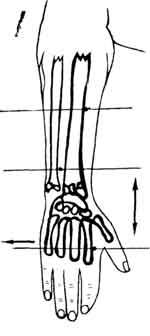 Схема проведения спиц при раздробленных переломах дистального суставного конца лучевой кости