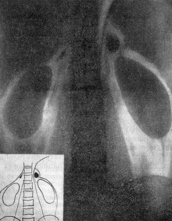 Рентгенограмма в условиях пневморетроперитонеума