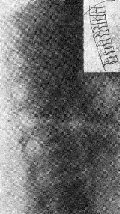 Рентгенограмма позвоночника