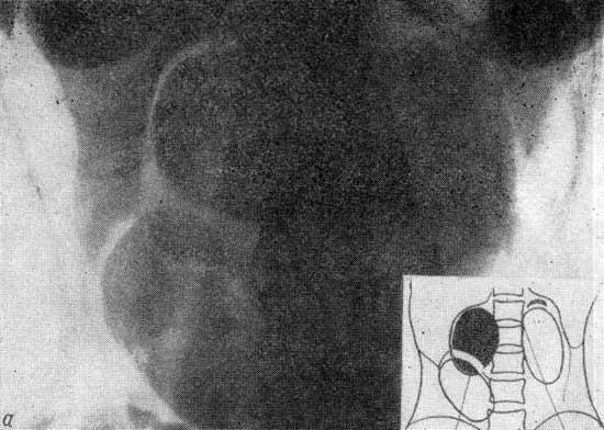 Феохромоцитома на рентгенограммах и томограммах
