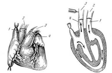 Трансплантация сердца на шею (Описание операции на реципиенте)