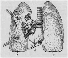 Аллотрансплантация левого легкого человеку (Magovern et al., 1964)