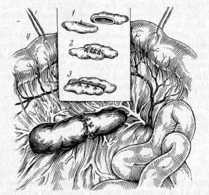 Техника формирования анастомоза лимфатических узлов брыжейки тонкой кишки (И. Д. Кирпатовский, 1966)